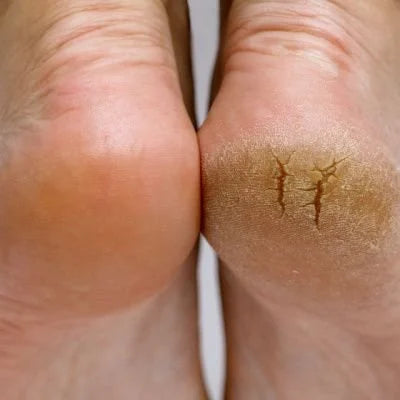 Feetcalm Foot & Heel Cracked Mouse + Peeling Mask