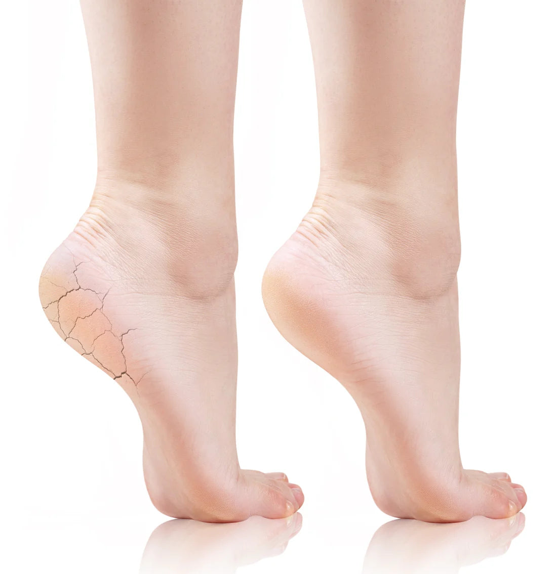 1+1 FALAS Feetcalm Cracked Heel Mousse 25% Urea 125ml