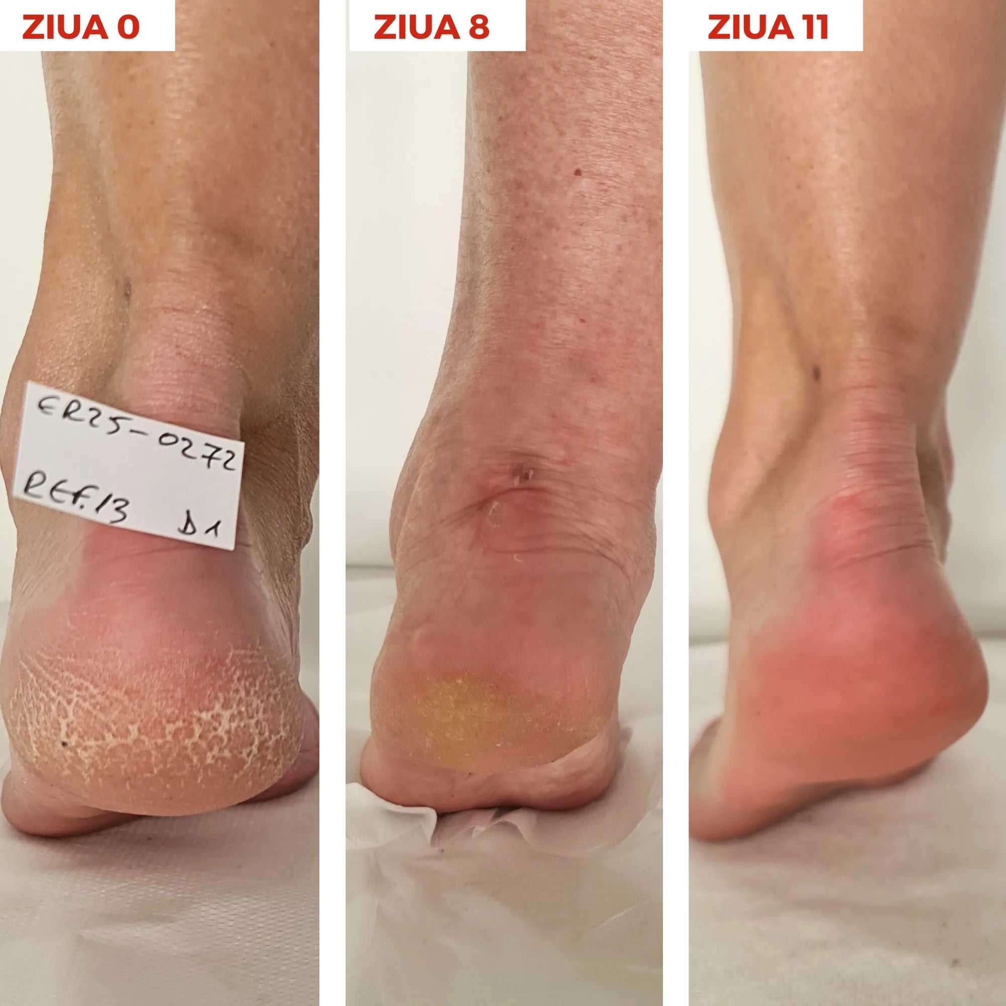 Synergy Therm Xerocare Anti-Calluses Cream With 40% Urea, Allantoin & Shea Butter 50ml