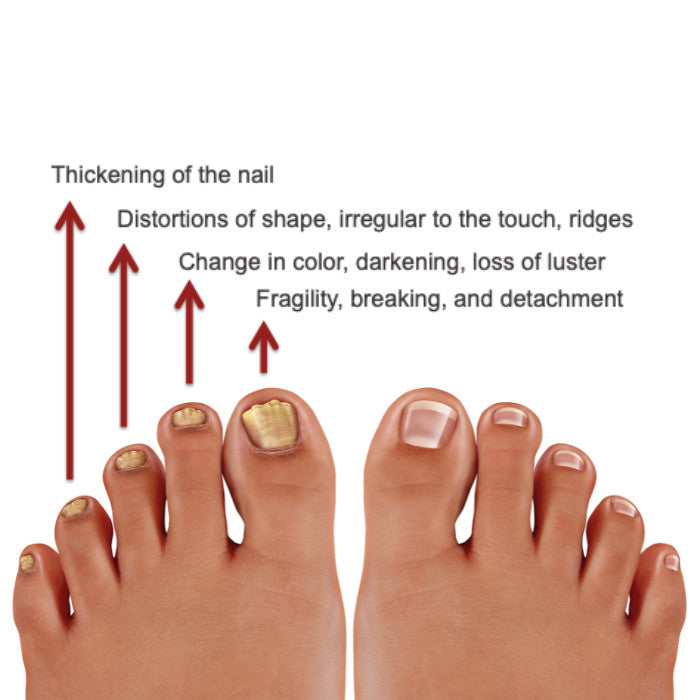 Feetcalm SOS Nail Repair Spray