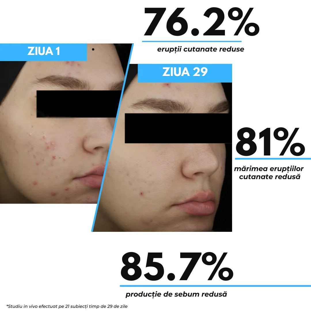 Synergy Therm Anti-Acne Cream 50 ml